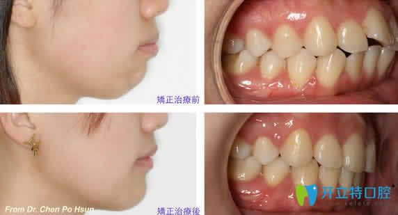 海口國雅口腔符基慶醫(yī)生隱形牙齒矯正案例效果圖