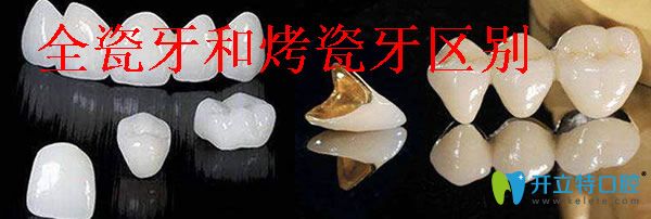 烤瓷牙和全瓷牙哪個(gè)好 分享全瓷牙和烤瓷牙之間有什么區(qū)別