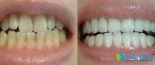 海南國雅口腔牙齒冷光美白效果圖