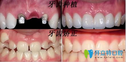 南京佑德口腔牙齒矯正和種植牙效果圖 南京佑德口腔牙齒矯正和種植牙效果圖