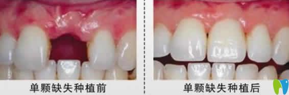?？趪?guó)雅口腔徐焰種植牙案例效果圖