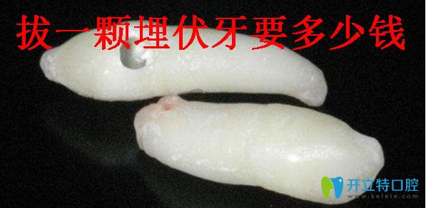 拔一顆埋伏牙要多少錢
