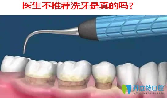 醫(yī)生不推薦洗牙是真的嗎