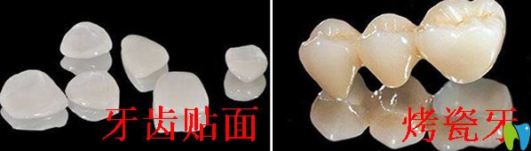 烤瓷牙好還是牙齒貼面好，區(qū)別是什么？具體答案都在這里