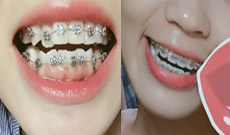 記錄我5個(gè)月來(lái)在武漢第一口腔醫(yī)院做牙齒正畸的體驗(yàn)，附圖