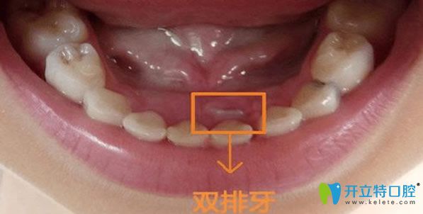 兒童雙排牙會(huì)自動(dòng)歸位嗎?雙排牙要不要拔?真相到底如何