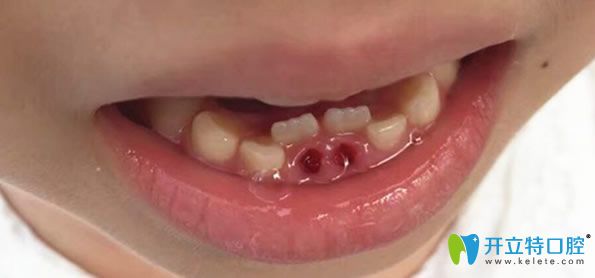 小孩雙排牙會自動歸位嗎