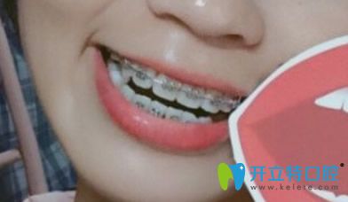 武漢第 一口腔醫(yī)院戴牙套第166天效果圖片展示