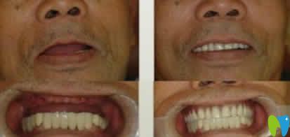 寧波協(xié)禾口腔王昭文院長全口牙種植案例效果