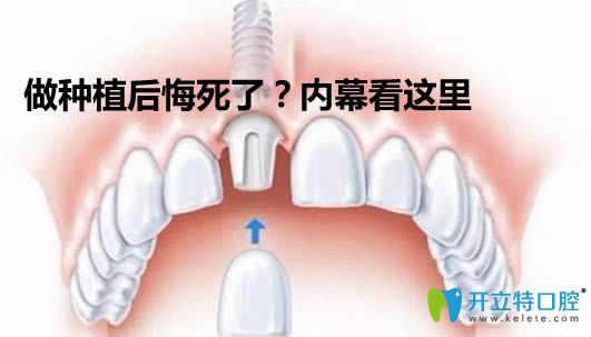 做了種植牙后悔死了?來看做過種植牙的人談體會與個人經(jīng)歷