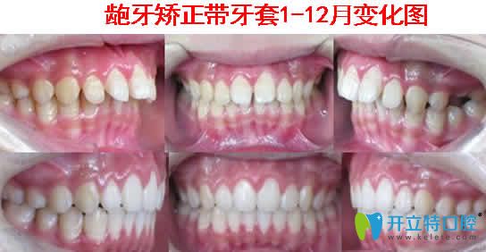 齙牙矯正帶牙套1到12個月變化圖