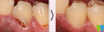 泉州補(bǔ)牙哪家好？來看牙博士口腔補(bǔ)牙治療前后對(duì)比案例
