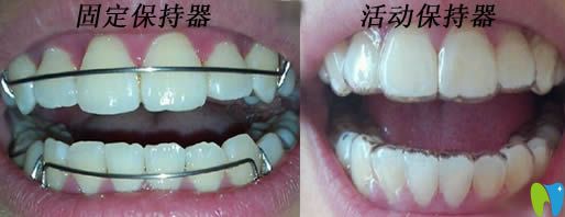固定保持器和活動(dòng)保持器圖