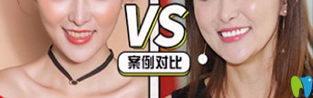 牙博士口腔泉州補(bǔ)牙哪家好？來看牙博士口腔補(bǔ)牙治療前后對(duì)比案例