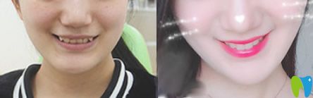 泉州牙博士矯正怎么樣？來看牙博士虎牙和深覆頜隱形矯正前后效果對(duì)比