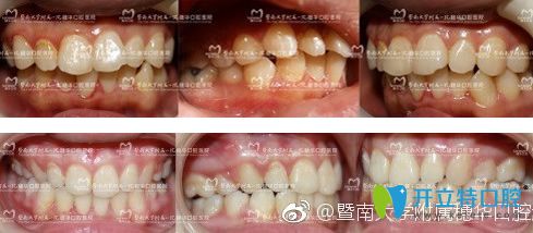 廣州穗華口腔隱形牙齒矯正對(duì)比圖