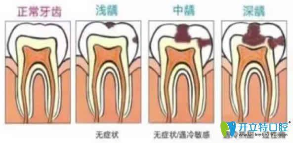 牙神經(jīng)疼能做根管治療嗎