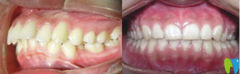 漢中小白象口腔真實(shí)牙齒矯正案例 漢中小白象口腔真實(shí)牙齒矯正案例