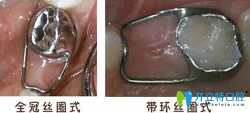 開立特口腔乳牙間隙保持器圖片