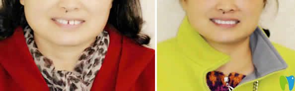 南昌輝煌口腔牙齒矯正案例效果圖 南昌輝煌口腔牙齒矯正案例效果圖