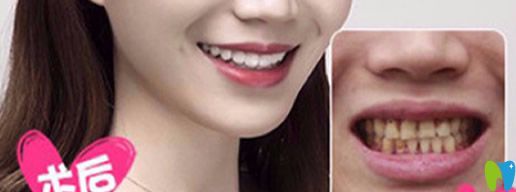 美萊美容生態(tài)美容牙修復(fù)案例
