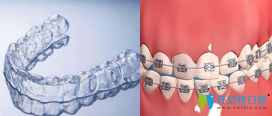 隱形透明牙套和鋼絲牙套哪個好?隱形牙套和鋼牙套區(qū)別對比