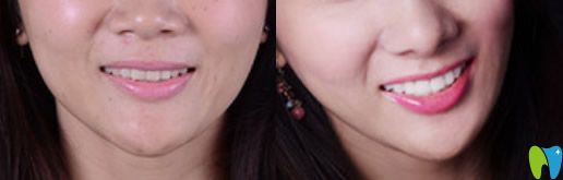 美萊瓷貼面修復(fù)牙齒案例前后效果對(duì)比圖