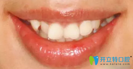 去<!--<i data=20240703-sp></i>-->美萊口腔做牙齒矯正前 去<!--<i data=20240703-sp></i>-->美萊口腔做牙齒矯正前