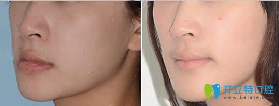 我在南昌安植雅口腔做牙齒矯正前后對比照 我在南昌安植雅口腔做牙齒矯正前后對比照