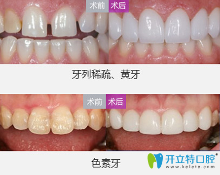 魏東牙貼面修復(fù)牙齒案例前后效果對比圖