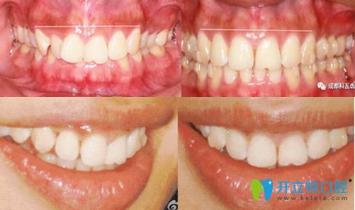 <!--<i data=20240703-sp></i>-->美萊口腔隱形矯正牙齒前后對(duì)比圖 <!--<i data=20240703-sp></i>-->美萊口腔隱形矯正牙齒前后對(duì)比圖