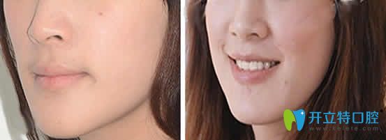 我在南昌安植雅口腔做地包天牙齒矯正2年效果 我在南昌安植雅口腔做地包天牙齒矯正2年效果