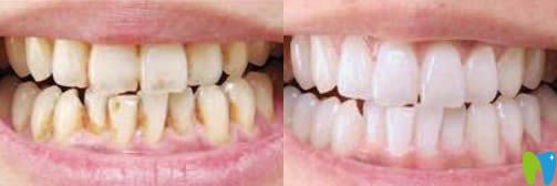 開立特口腔牙齒冷光美白效果對比圖