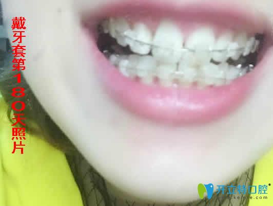 我在合肥世佳口腔做陶瓷托槽矯正180天照片 我在合肥世佳口腔做陶瓷托槽矯正180天照片