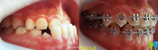 瑾帆口腔替牙期的地包天矯正案例