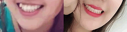 武漢斯美爾口腔牙齒矯正前后對(duì)比圖