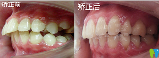 桂林瑾帆口腔好不好？真人牙齒矯正案例及術(shù)后反饋來(lái)驗(yàn)證