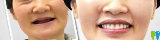 中山維爾口腔60歲老人全口種植牙案例對比圖 中山維爾口腔60歲老人全口種植牙案例對比圖