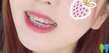 武漢斯美爾口腔矯正第200天效果圖