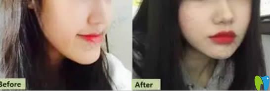 齙牙矯正案例效果及前后對比照 齙牙矯正案例效果及前后對比照