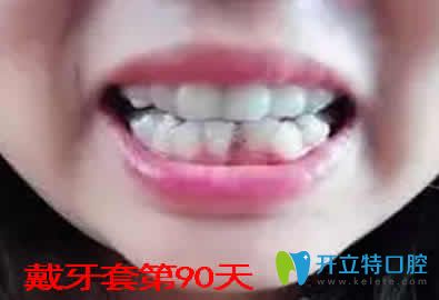 我在重慶嘉悅口腔做牙齒矯正第90天照片