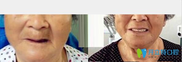 中山維爾口腔All-on-4全口種植牙真實案例 中山維爾口腔All-on-4全口種植牙真實案例