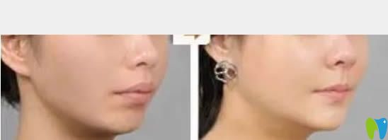 中山維爾口腔齙牙矯正后臉型對比圖 中山維爾口腔齙牙矯正后臉型對比圖