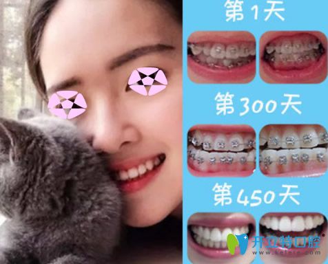 成人矯正牙齒效果好嗎？看上海伊爾意口腔正畸前后對比圖