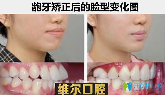 齙牙矯正后臉型對(duì)比案例