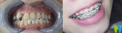 北京誠之康口腔正畸怎么樣？來看對比圖