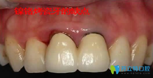 鎳鉻烤瓷牙的優(yōu)缺點