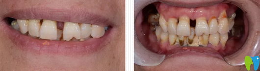 在鄭州未來口腔種植牙前