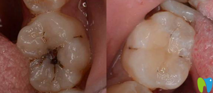 陳蔚蔚主任根管治療案例前后效果對(duì)比圖