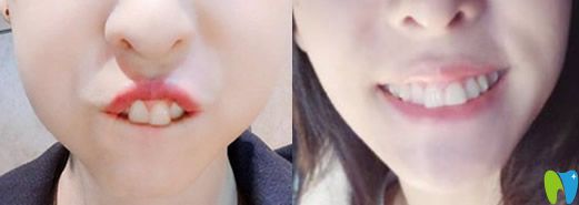 歌手張碧晨隱形矯正牙齒對(duì)比照